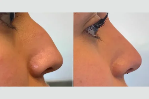 هر آنچه پیش از تزریق فیلر بینی باید بدانید