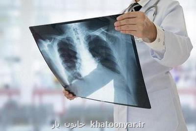 بازماندگان بیماری سل در معرض ریسك بالای صدمه ریه