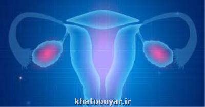 همه چیز درباره سندروم تخمدان پلی كیستیك